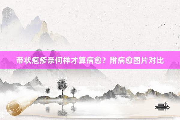 带状疱疹奈何样才算病愈？附病愈图片对比